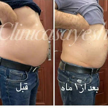 لاغری بدون جراحی با کرایولیپولیز