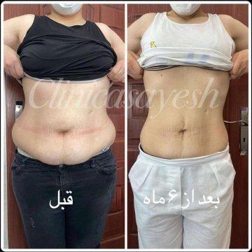 لاغری بدون جراحی با کرایولیپولیز